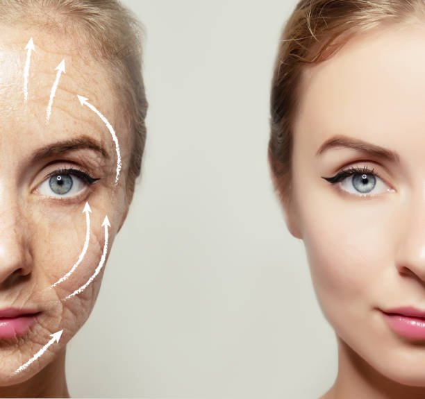 Imangen redensificación y retención facial